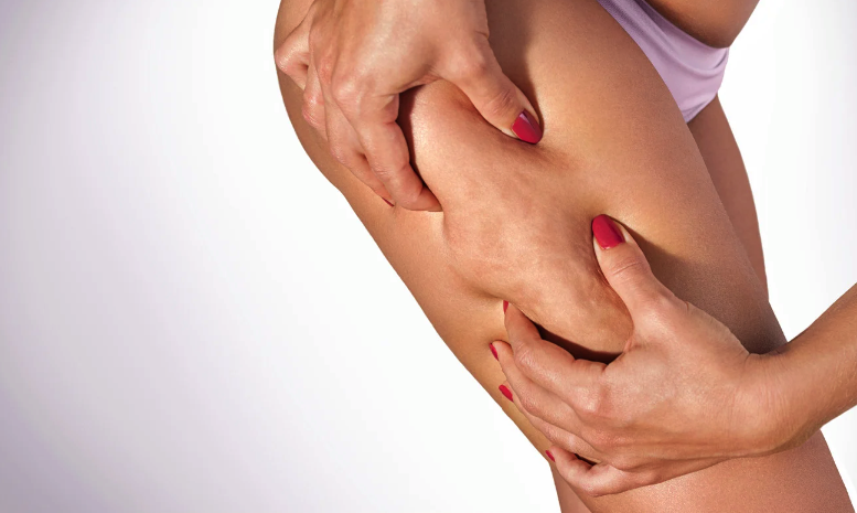 Cómo eliminar la celulitis de las piernas