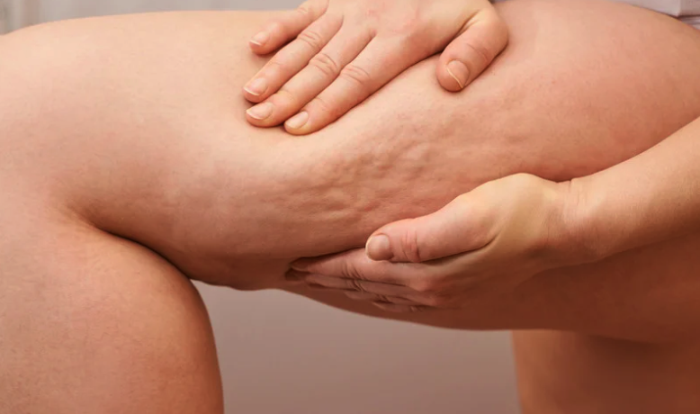 Cómo eliminar la celulitis de los muslos